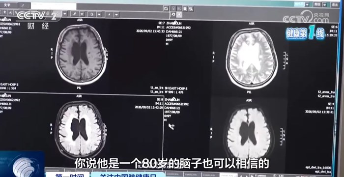 49歲男子長期熬夜刷手機，大腦萎縮如80歲！這些傷腦行為，你可能天天在做